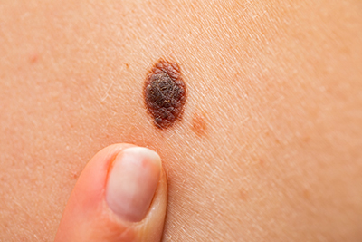Spots and Dots: Identifying Skin Cancer and Liver Spots