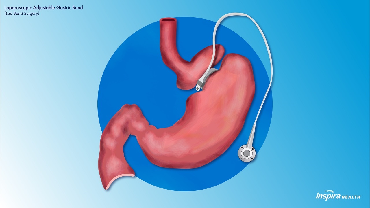 Laparoscopic Adjustable Gastric Band (Lap Band Surgery) Illustration Inspira Health