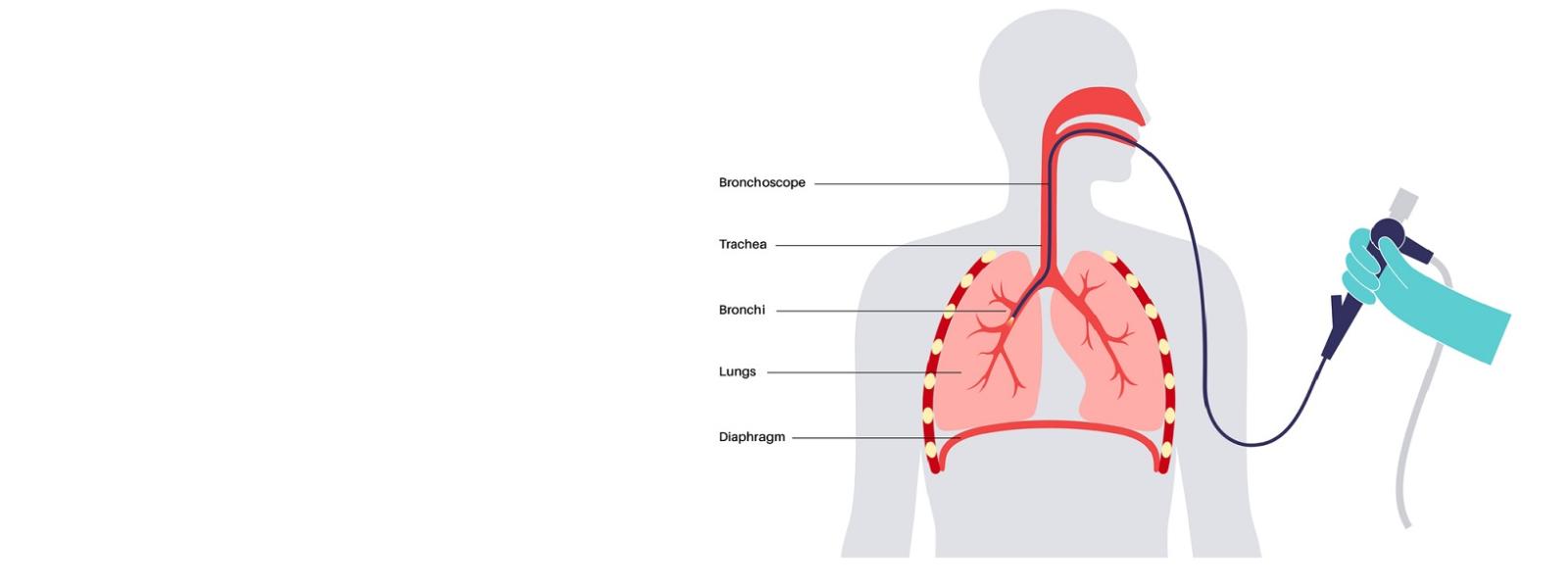 Pulmonary Endoscopy diagram