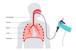 Pulmonary Endoscopy diagram